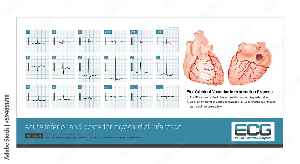 Distal occlusion of the right coronary artery can cause inferior and