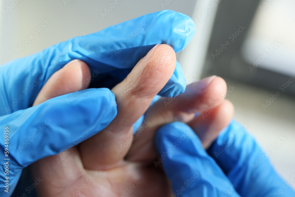 Doctor in rubber gloves examines patient fingers with eczema
