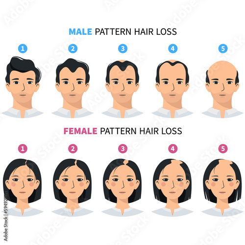 Hair loss stages, androgenetic alopecia male and female pattern. Steps of baldness vector infographic in a flat style with a man and a woman png