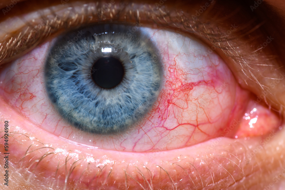 Czerwone oko od alergii z popękanymi naczynkami - obrazy, fototapety, plakaty 