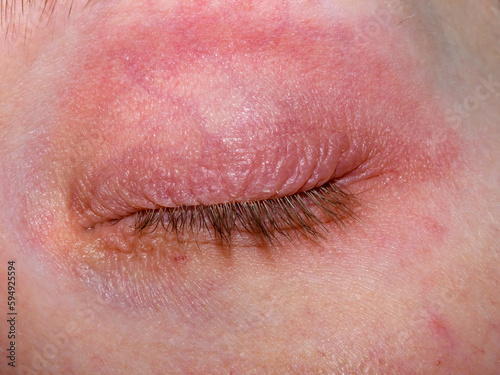 Zamknięte spuchnięte i zaczerwienione powieki z alergią z bliska photo