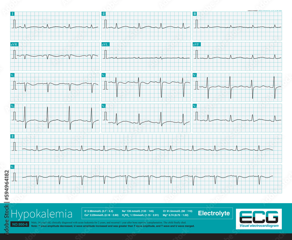 A 14 year old Boy With Leukemia Developed Recurrent Ventricular 