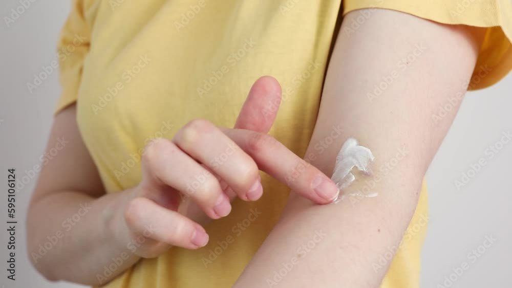 Closeup Female Person Applies Healing Cream, Ointment On Hematoma