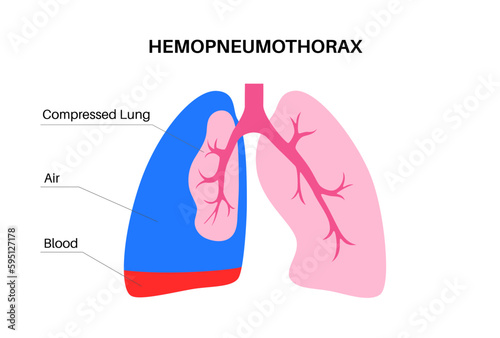 Hemopneumothorax medical poster photo