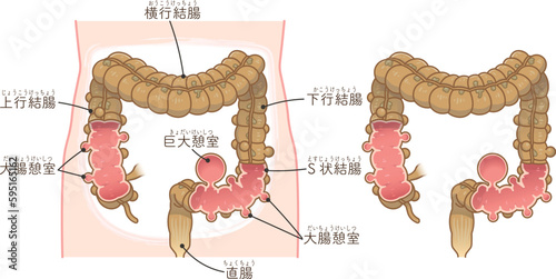 大腸憩室・憩室穿孔・憩室・Diverticulumのイラスト