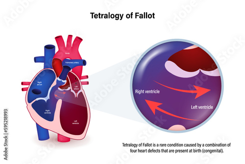 Tetralogy of Fallot vector. Congenital heart disease. 
