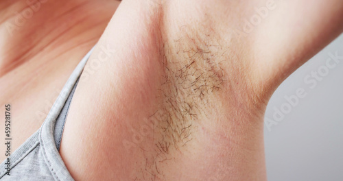 Young Woman With Hairy Armpit. Hair Removal