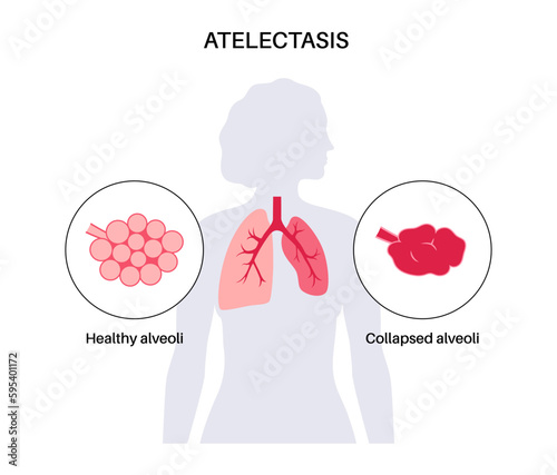 Atelectasis medical poster