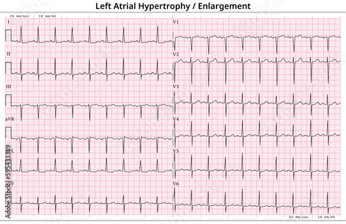 ECG Left Atrial Hypertrophy (LVH) - Left Atrial Enlargement (LAE) - 12 Lead ECG Common Case - 6 Sec/lead - Medical Vector Illustration