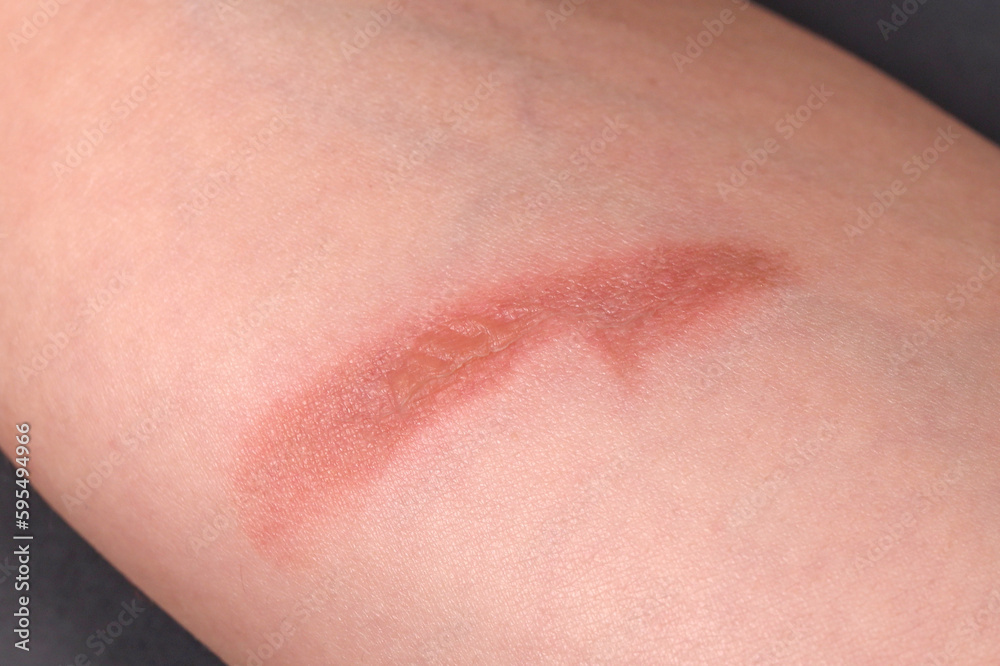 Thermal burn on human skin close up, home accident Thermal burn on human skin close up, home accident