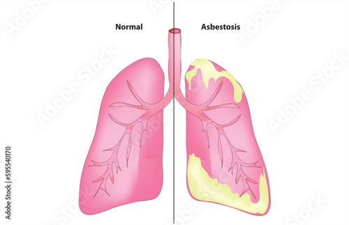 Asbestosis