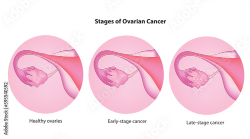 Stages of Ovarian Cancer