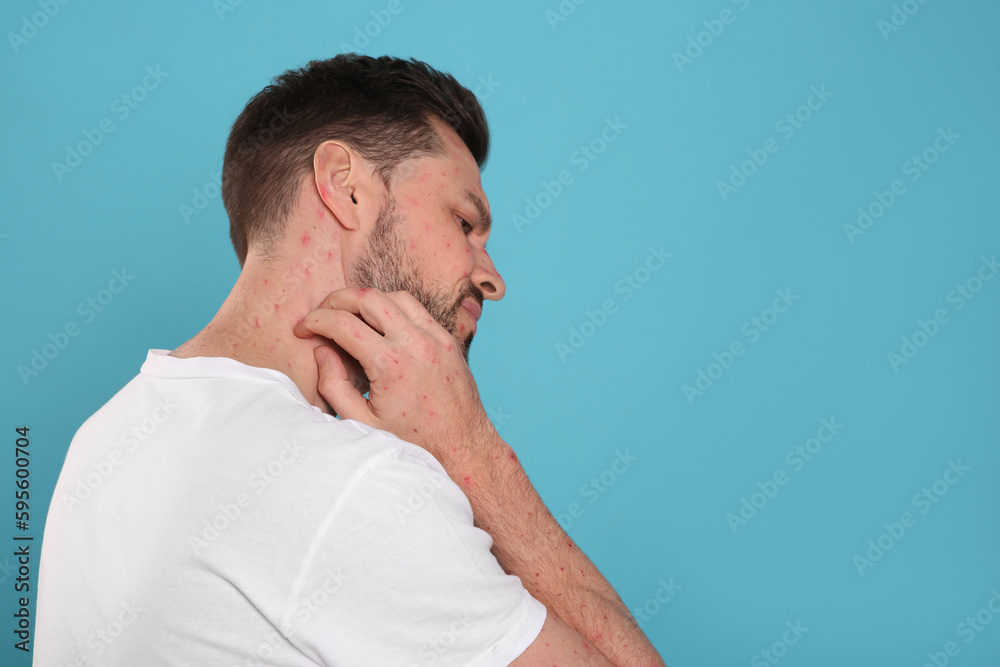 Man with rash suffering from monkeypox virus on light blue background. Space for text Man with rash suffering from monkeypox virus on light blue background. Space for text