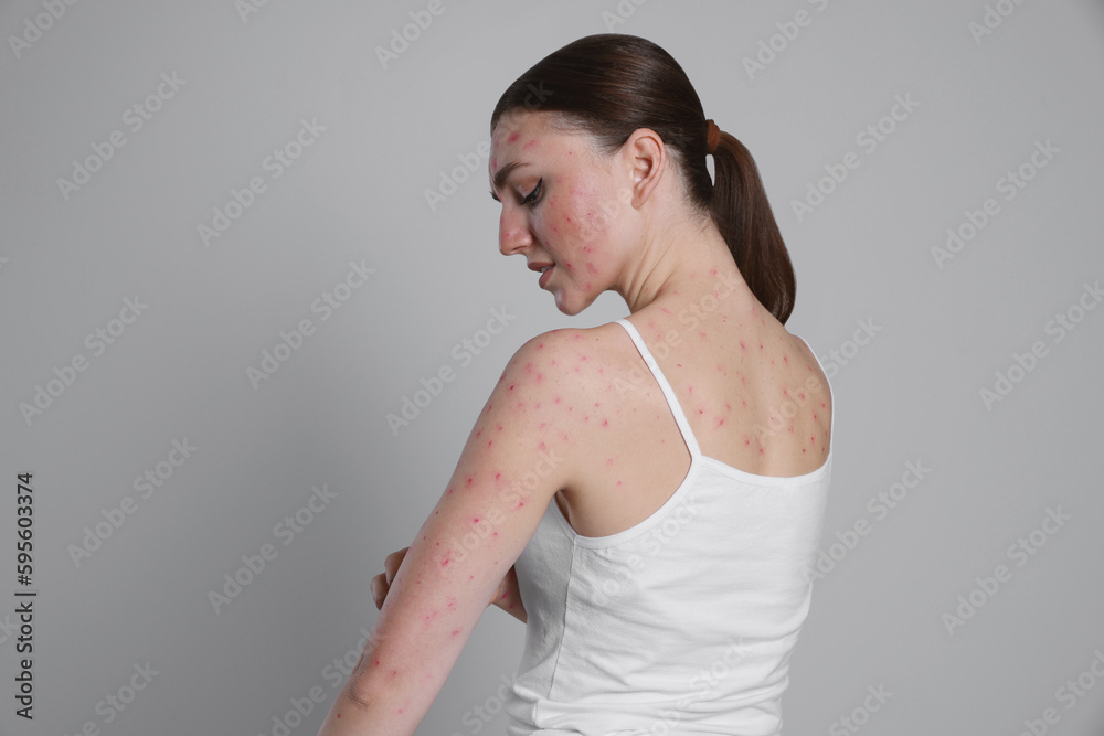 Woman with rash suffering from monkeypox virus on light grey background Woman with rash suffering from monkeypox virus on light grey background
