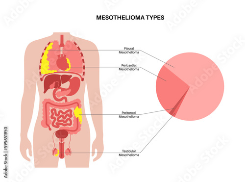 Mesothelioma tumor types
