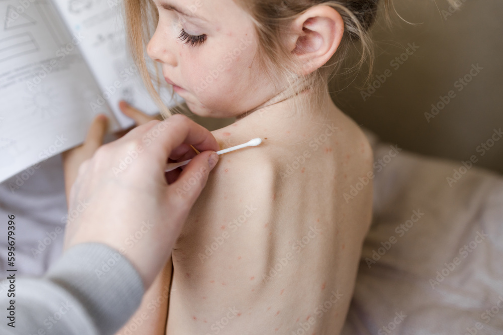 Obraz premium Little girl sitting with her back to camera and looking at treatment of ulcers from chickenpox, varicella with medical cream. Kid with red rash sitting in bed and holding book