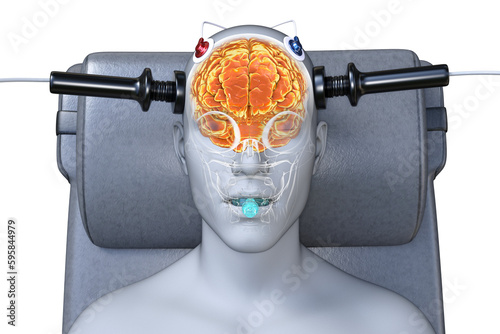 Electroconvulsive therapy, ECT, a treatment involving the use of electrical currents to stimulate the brain, 3D illustration photo