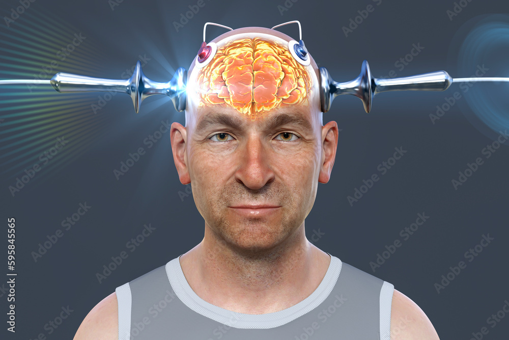 Electroconvulsive therapy, ECT, a treatment involving the use of