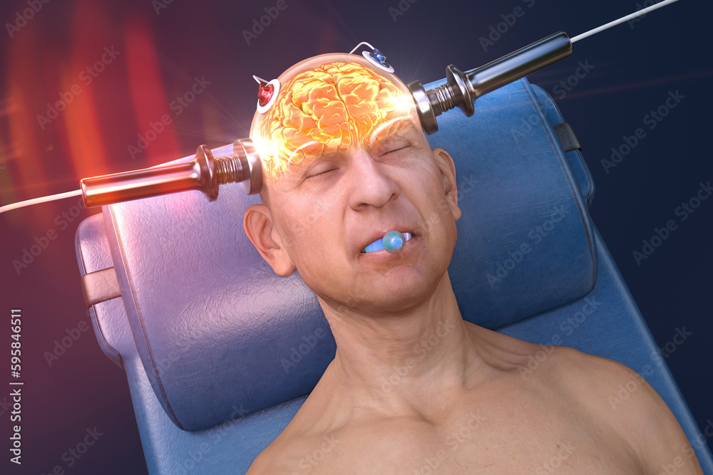 Electroconvulsive therapy, ECT, a treatment involving the use of