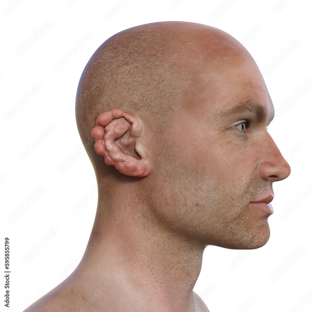 Obraz premium Ear lobomycosis nodules, a chronic skin disease caused by microscopic fungi Lacazia loboi, 3D illustration