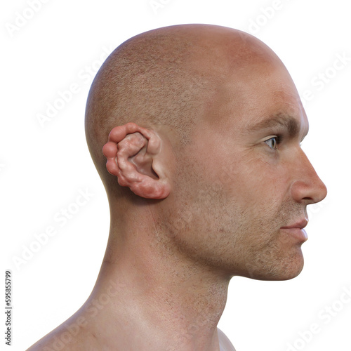 Ear lobomycosis nodules, a chronic skin disease caused by microscopic fungi Lacazia loboi, 3D illustration