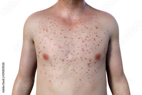 A skin rash on the chest of a patient with Marburg hemorrhagic fever, 3D illustration photo