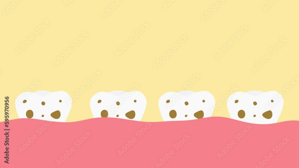 Caries appears on the teeth. Teeth in the oral cavity. Caries appears on the teeth. Teeth in the oral cavity.