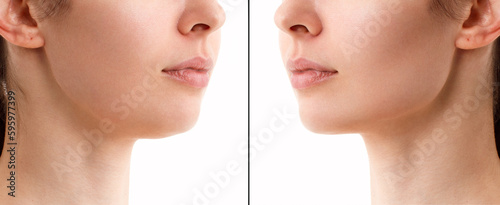 A close portrait of a woman before and after the facial rejuvenation procedure. Correction of the chin shape liposuction of the neck. Fillers in the cheekbones and chin. The result of the procedure in