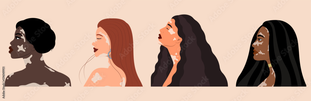 Set of young women with vitiligo on beige background Set of young women with vitiligo on beige background