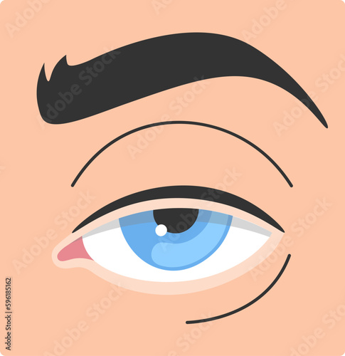 Ptosis Human Eye Disease