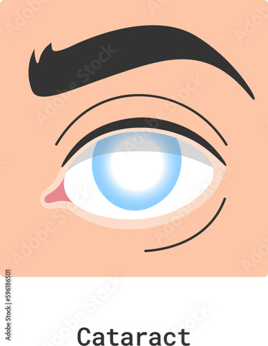 Cataract Human Eye Disease