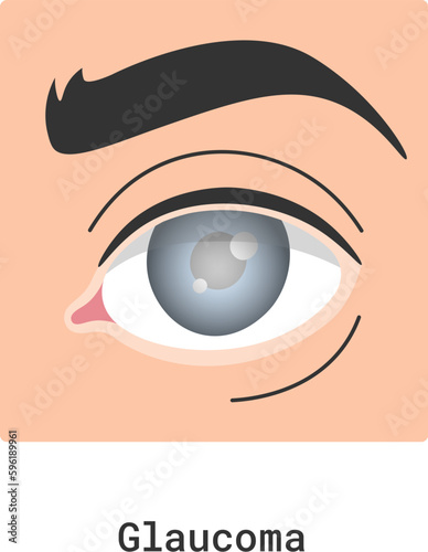 Glaucoma Human Eye Disease