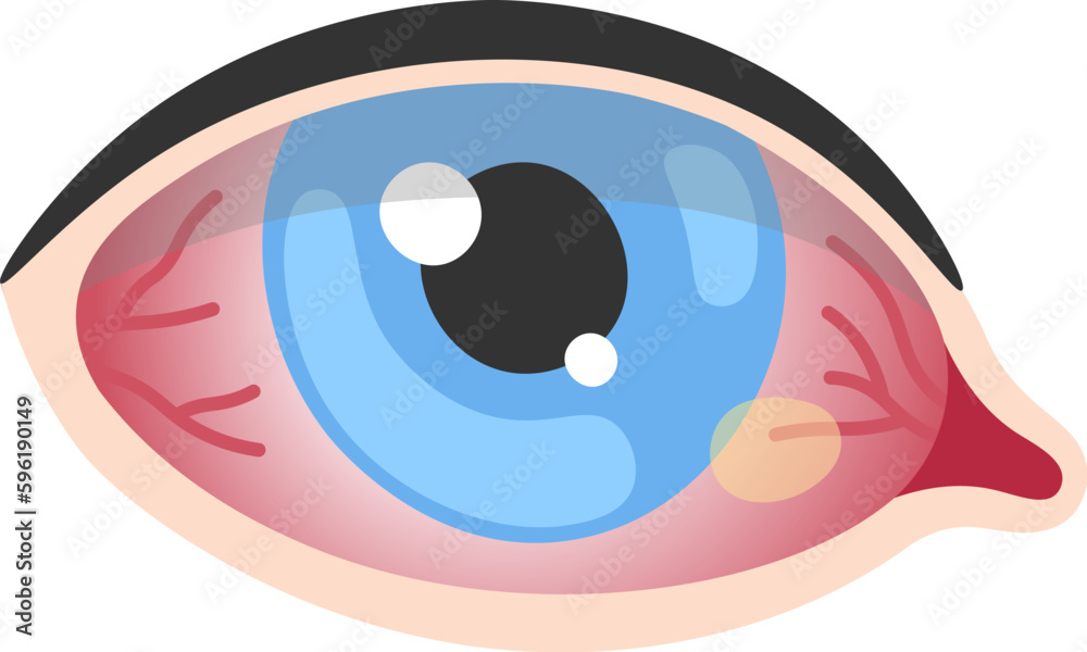 Pinguecula Human Eye Disease Pinguecula Human Eye Disease