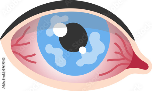 Corneal Herpes Epithelial Type Eye Disease
