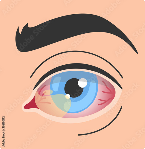 Pterygium Human Eye Disease