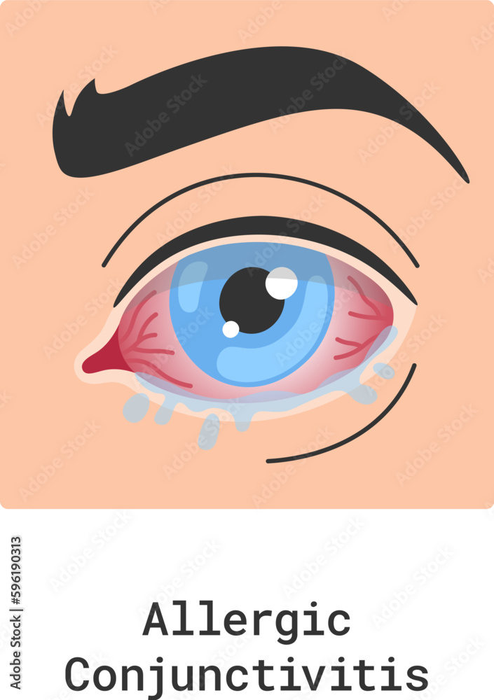 Allergic Conjunctivitis Eye Disease Allergic Conjunctivitis Eye Disease