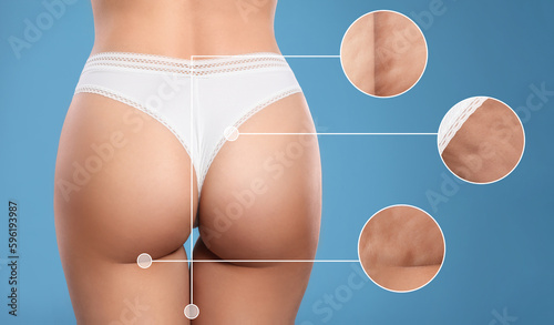 Cellulite problem. Slim woman in underwear on light blue background, closeup. Zoomed skin areas with orange peel syndrome