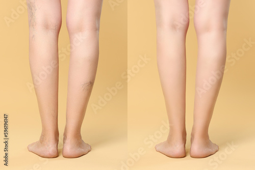 Before and after varicose veins treatment. Collage with photos of woman showing legs on yellow background, closeup