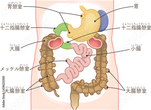 大腸憩室・憩室穿孔・憩室・Diverticulum・メッケル憩室・メッケル憩室癌のイラスト