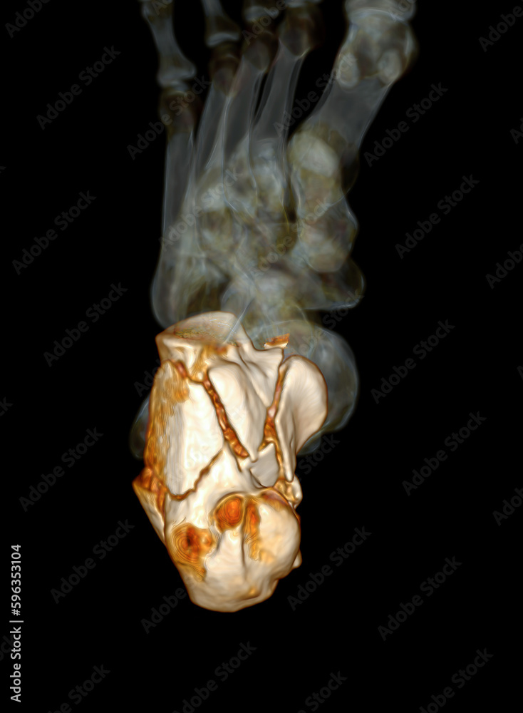 CT Scan ankle joint with 3d rendering of calcaneus bone showing