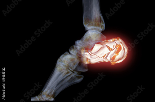 CT Scan ankle joint with  3d rendering of calcaneus bone showing Calcaneus (Heel Bone) Fractures. photo