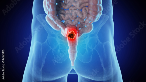 3d medical illustration of rectal cancer photo