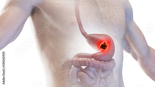 3d medical illustration of stomach cancer photo