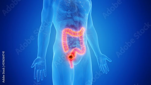 Foto 3D rendered Medical Illustration of Male Anatomy - Rectal Cancer.