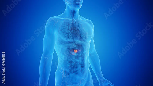 3D Rendered Medical Illustration of Male Anatomy - Pancreatic Cancer.