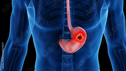3d rendered medical illustration of stomach cancer photo