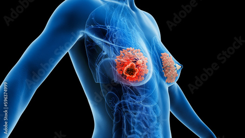 3d rendered medical illustration of breast cancer photo