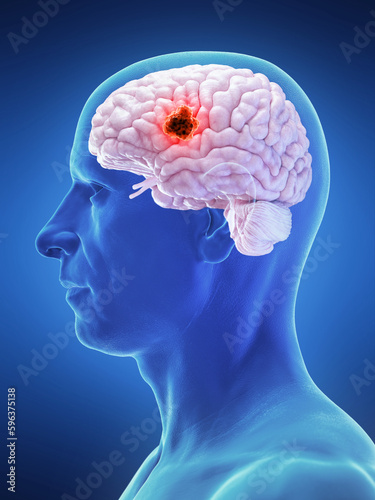 3d rendered medical illustration of brain cancer