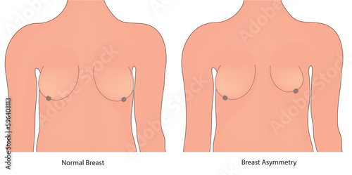 breast asymmetry