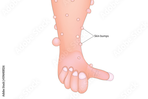 Neurofibromas